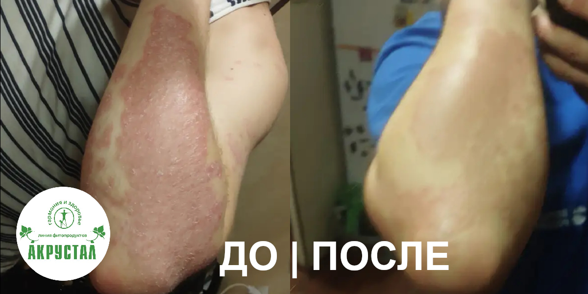 Акрустал от псориаза