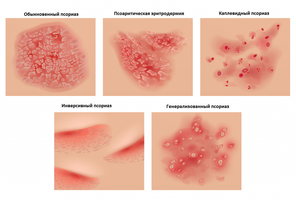 Лечение псориаза в интимной зоне у женщин