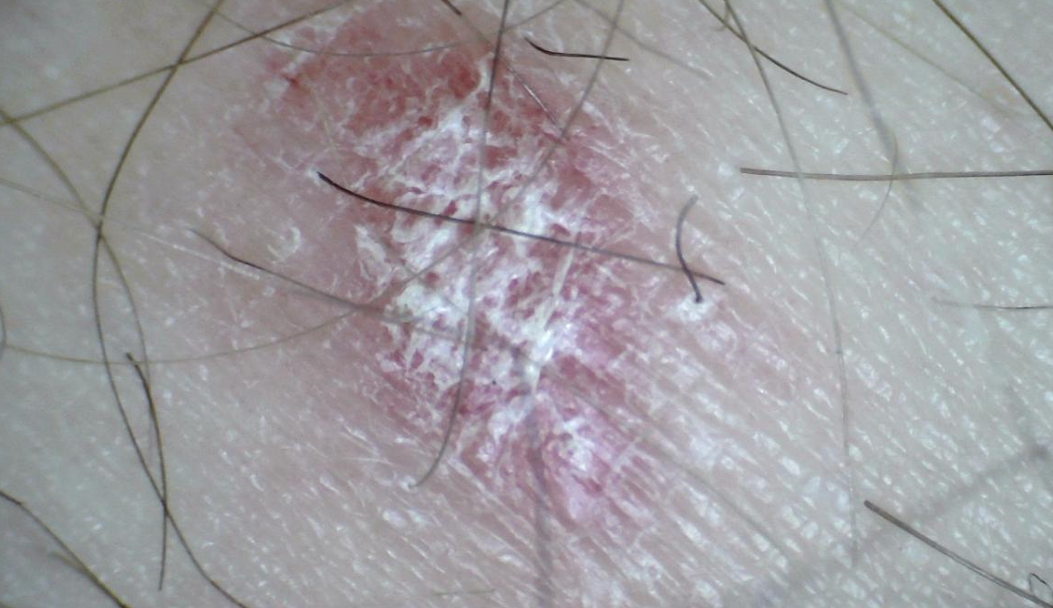 Псориаз в паху