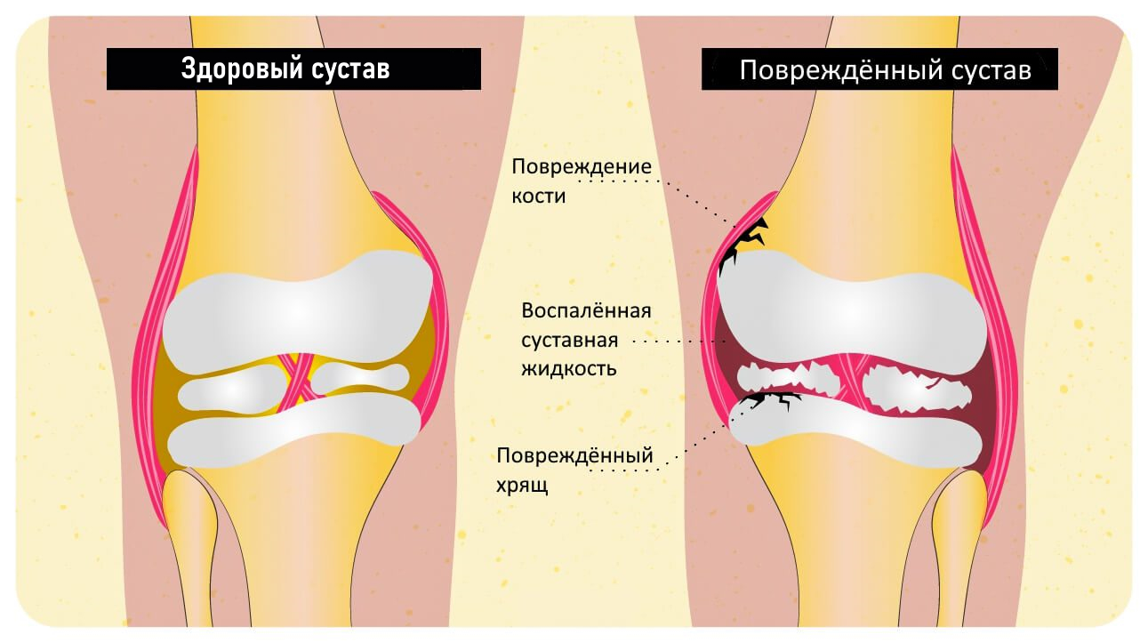 Лечение псориаза суставов