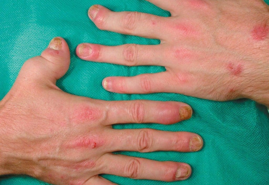 Псориаз суставов