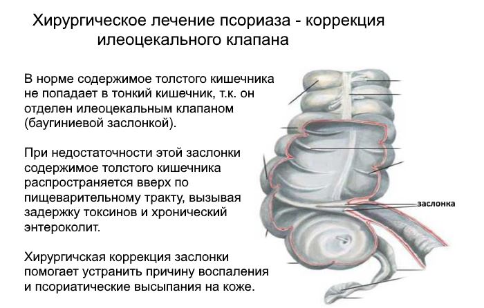 Илеоцекальный клапан губовидной формы