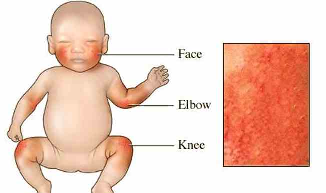 Псориаз у детей